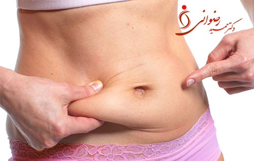 abdominoplasty