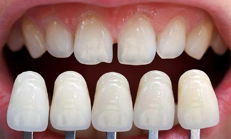The-best-brand-of-removable-dental-laminate