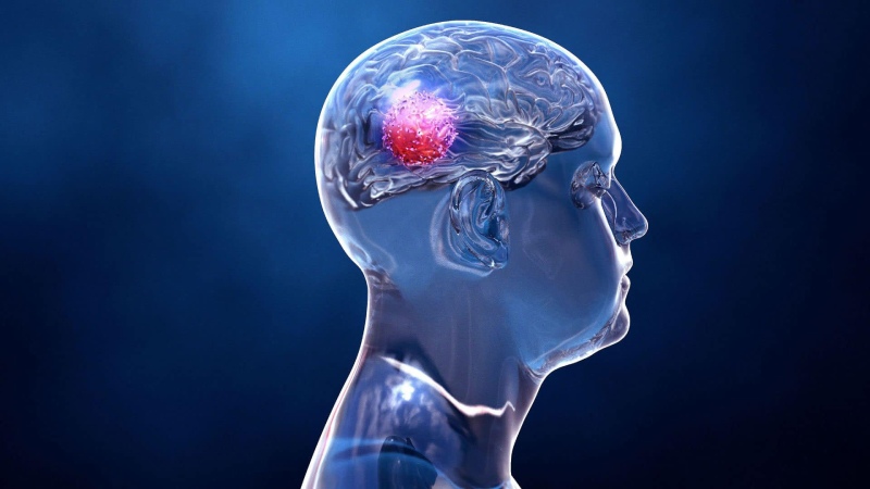 ۷ نشانه هشدار دهنده تومور مغزی که نباید نادیده گرفته شوند