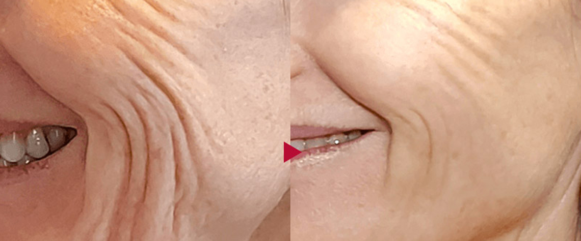 ترکیب سرم با روتین مراقبت روزانه